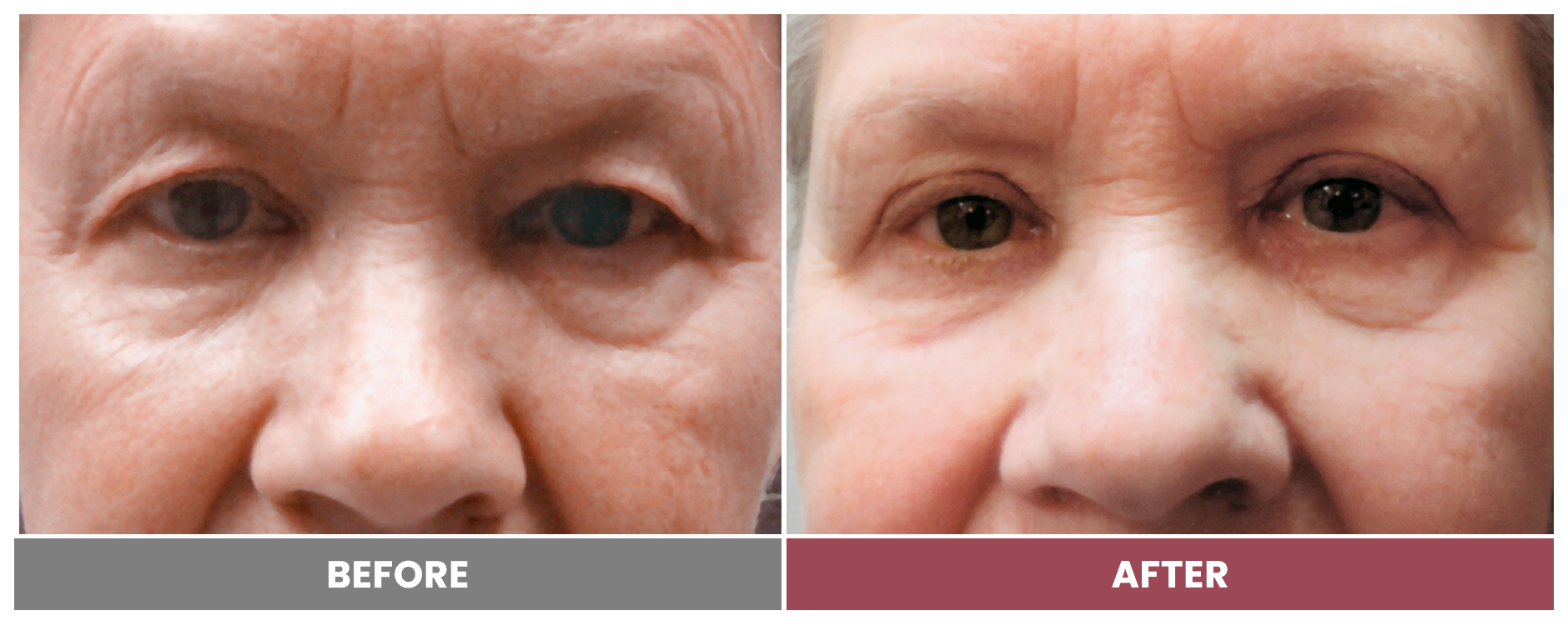 Upper Blepharoplasty - Case 100